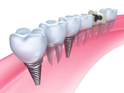 Dental Implants Des Plains IL 